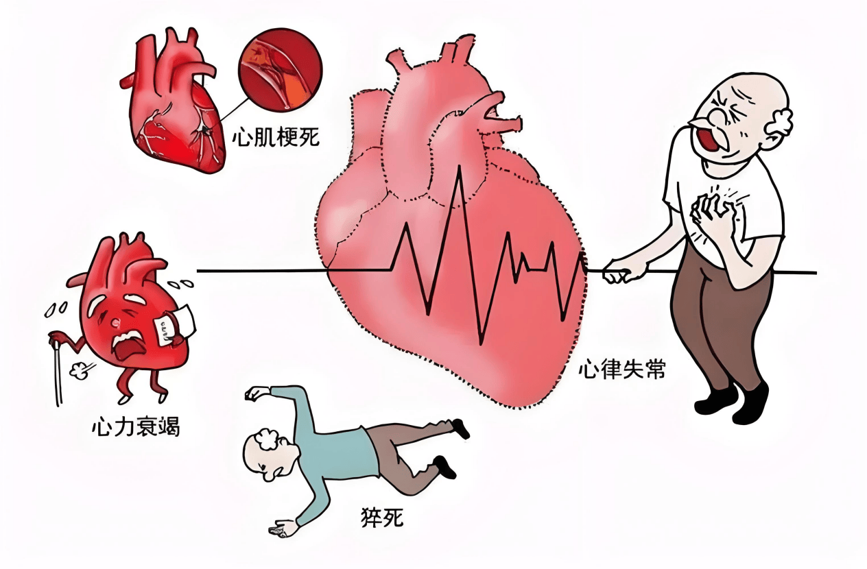 刘振医生：猝死前兆！心梗发作前的6个信号，很多人当成小毛病！