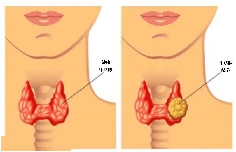 查出甲状腺结节，还能食用碘盐吗？