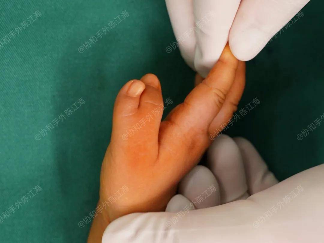 原创            多指│案例29《为了娃，我比他爸爸还要狠心》