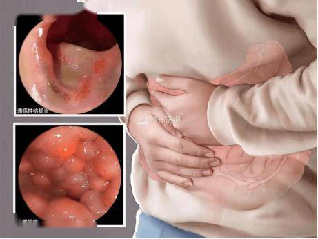 【朝医科普】高压氧治疗炎症性肠病，穿透肠壁的“氧气革命”