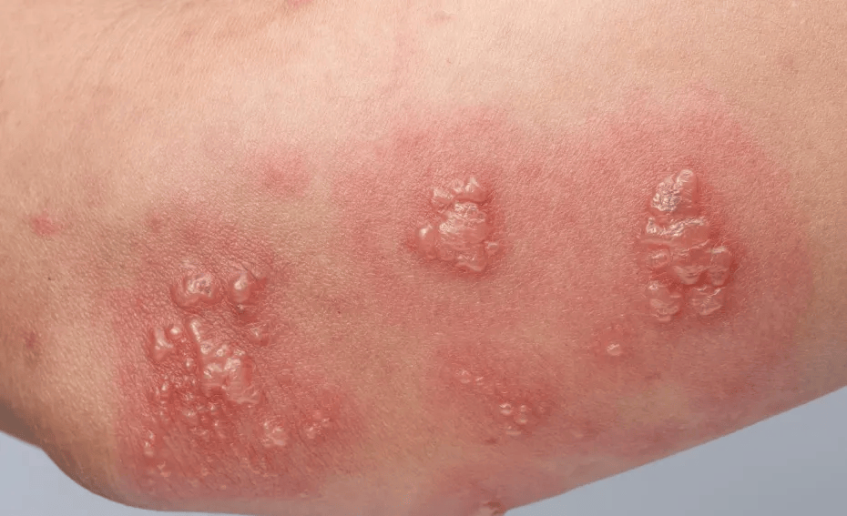 手指起泡、湿疹反复？可能是这个脏器虚了，别只知道“祛湿”