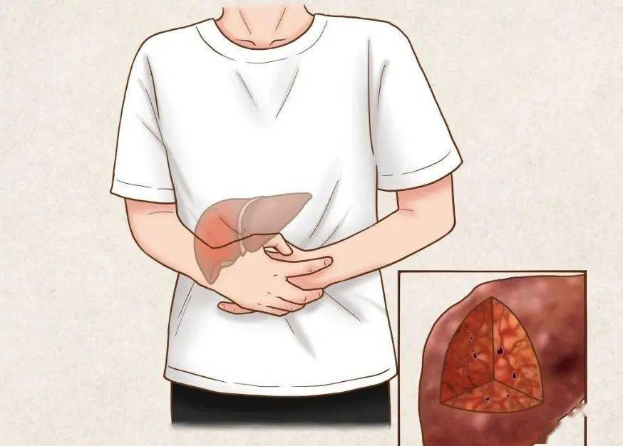 肠道菌群失调，竟成癌症“帮凶”？促转移复发！