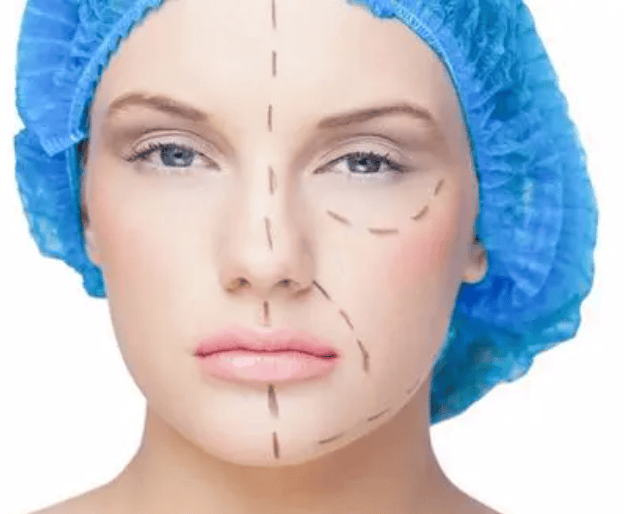 筋膜折叠提升是什么原理、筋膜折叠提升图解全解析~