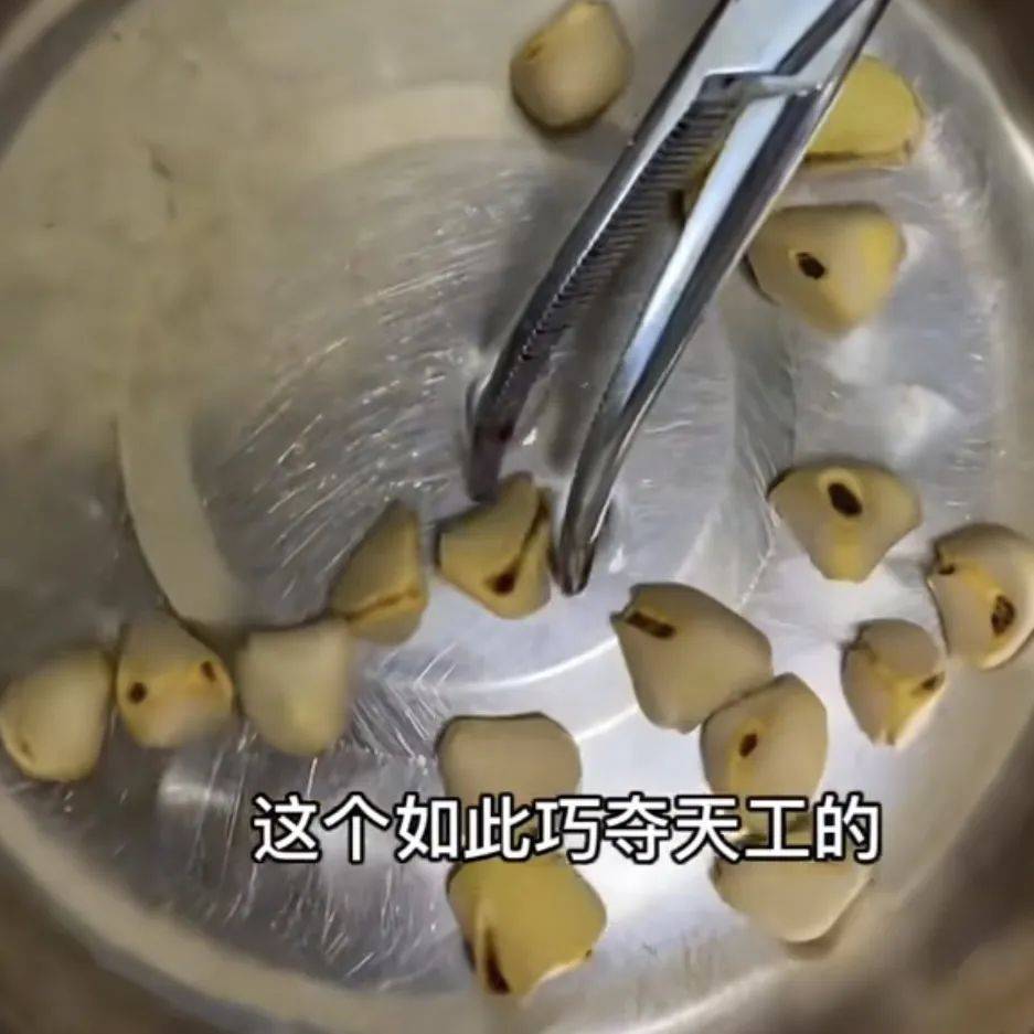 胆囊内惊现18颗“开心果”，网友：这“品控”太到位了！