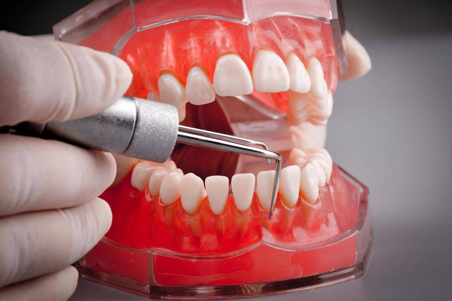 牙周炎治疗的四个过程