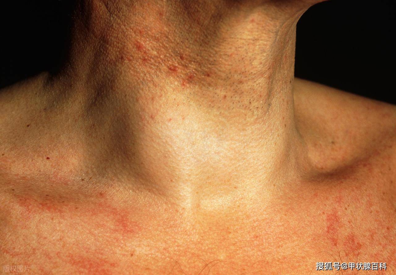 广东华楠医院：桥本甲状腺炎--抗体高但甲功正常，需要治疗吗？