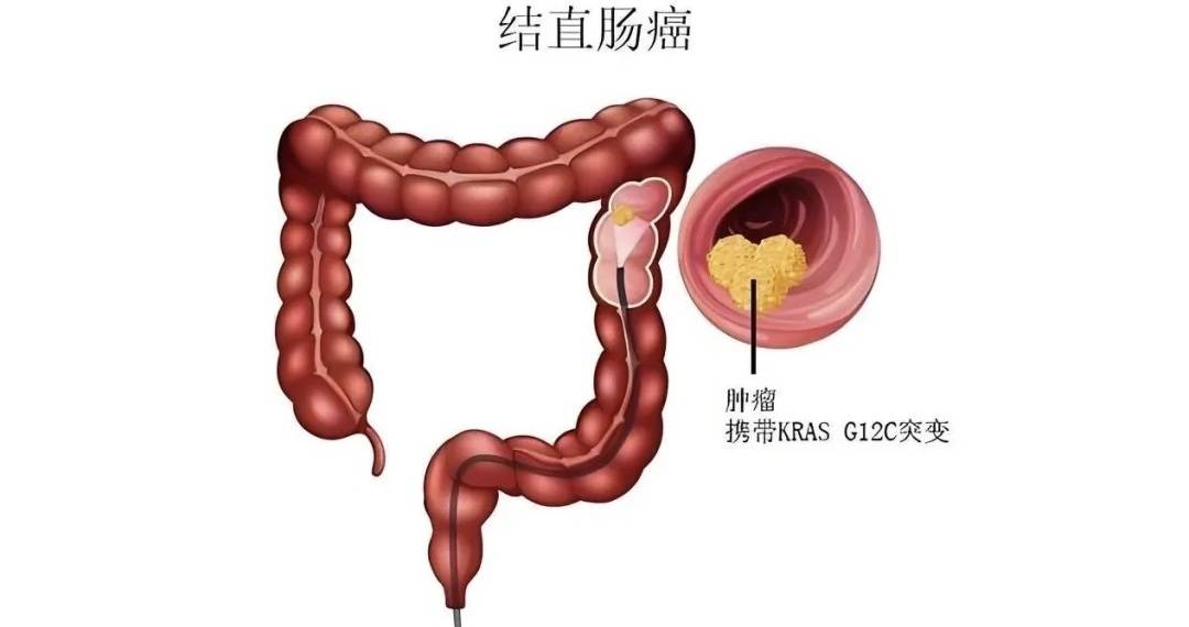 原创            科学应对肠癌晚期治疗：如何平衡化疗与舒缓的保守治疗方案？