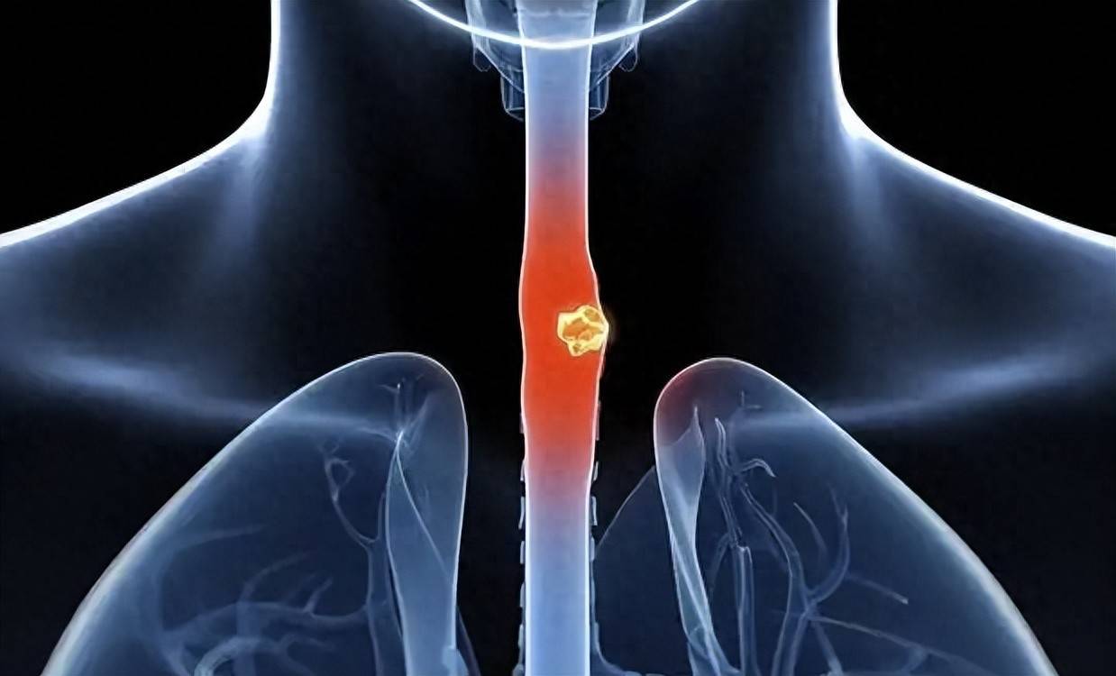 原创            食道癌早期3类信号别忽视，45岁以上症状超过2周，快进行胃镜检查