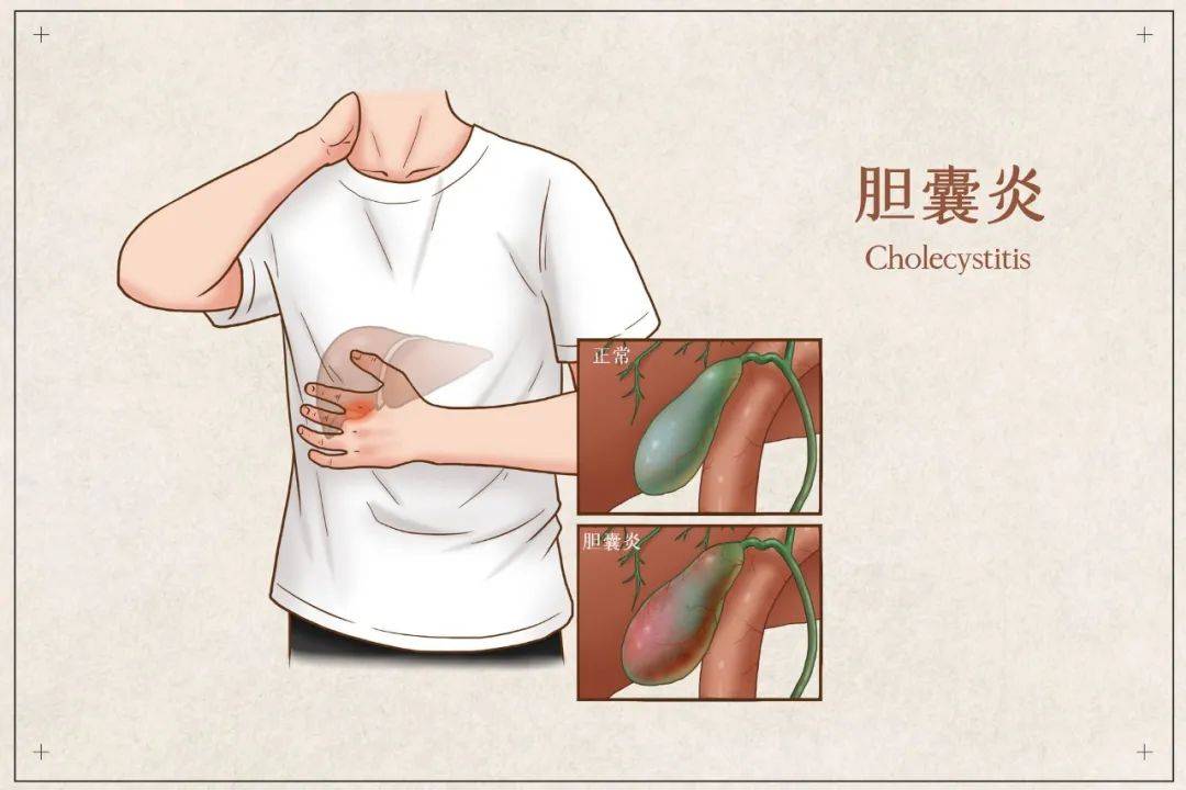 不规律吃饭 当心胆囊炎