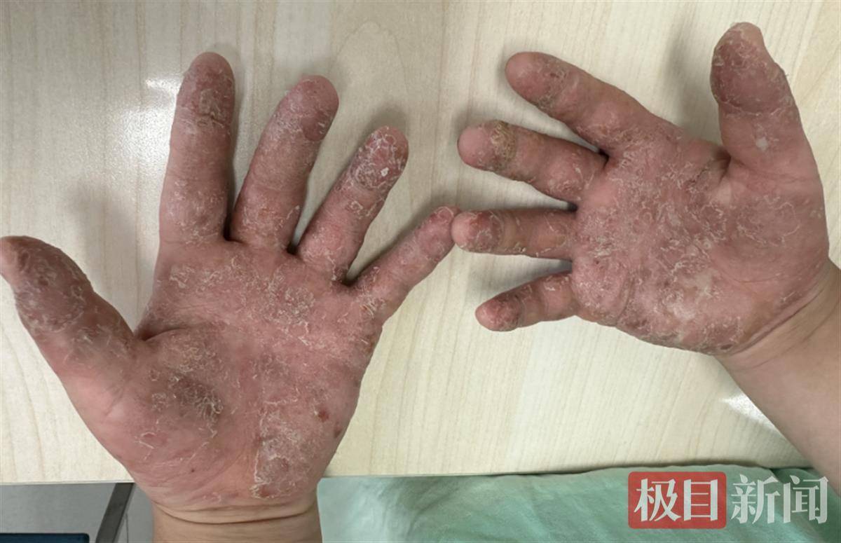 花椒煮水加醋祛湿气？奶奶上偏方泡手，孙子双手溃烂流水