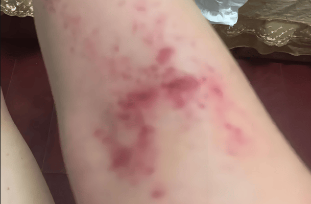 杨淑莲医生：系统性红斑狼疮，引起血小板减少，正确用药是关键