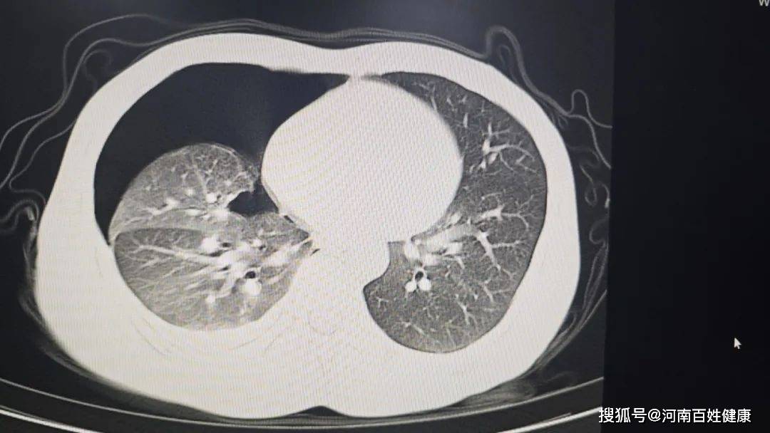 年轻帅哥深夜爆肺！ 别让颜值优势变成健康隐患