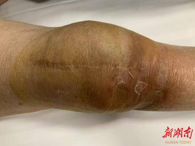 七旬老人重燃“膝”望：看这家医院如何攻克复杂膝关节翻修难题