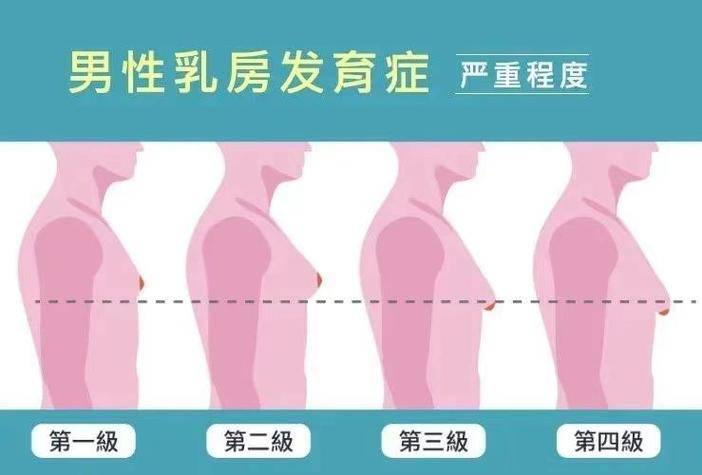 男性乳腺发育：不容忽视的健康隐忧