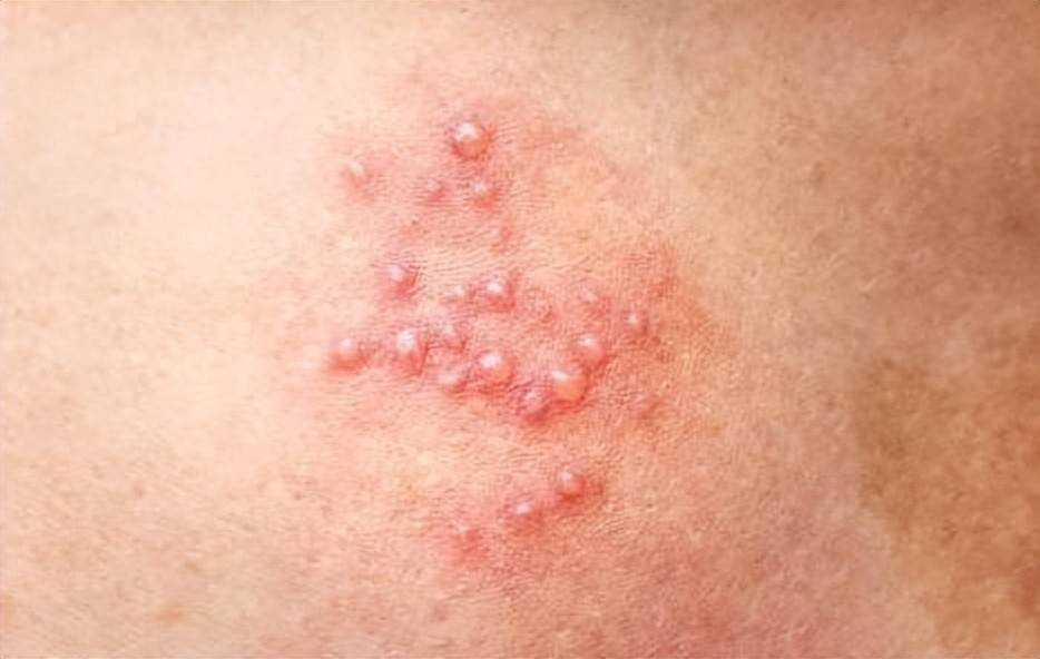 生殖器疱疹患者饮食大忌，吃错可能加重病情