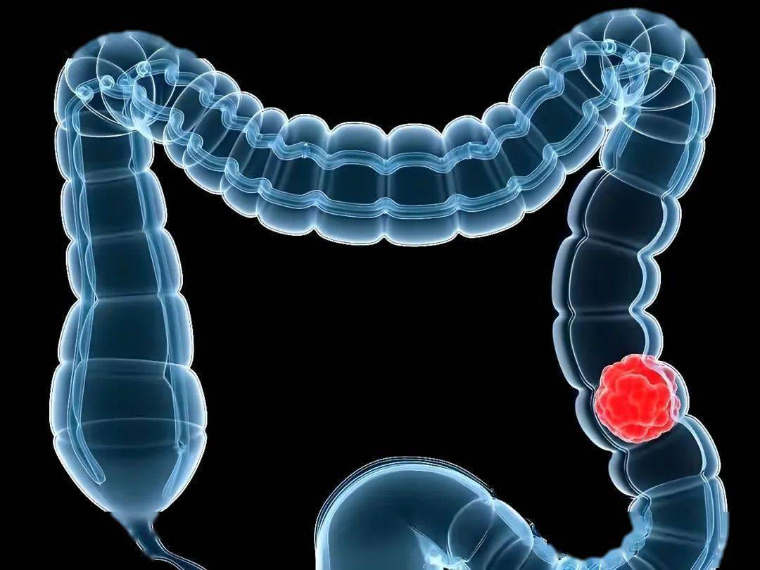 结直肠癌治疗新靶点！南方医科大学研究：可逆转耐药并抑制远处转移