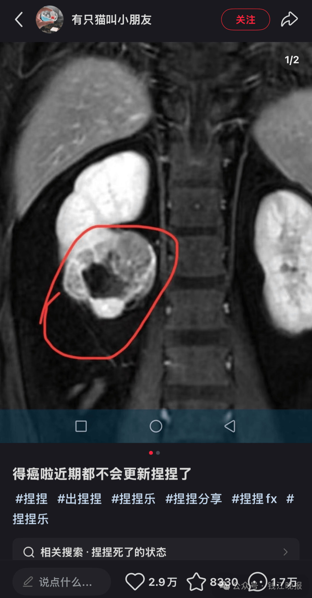 玩具博主自曝患癌！“捏捏”还能玩吗？