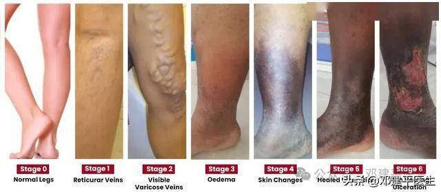 治疗静脉曲张最容易犯的9大错误和误区