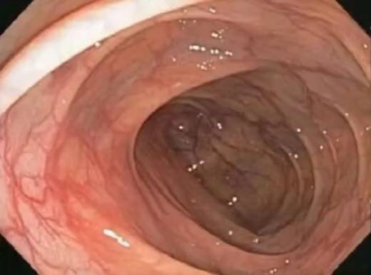 这种息肉可能会变成癌 排便出现4种异常建议及时就医