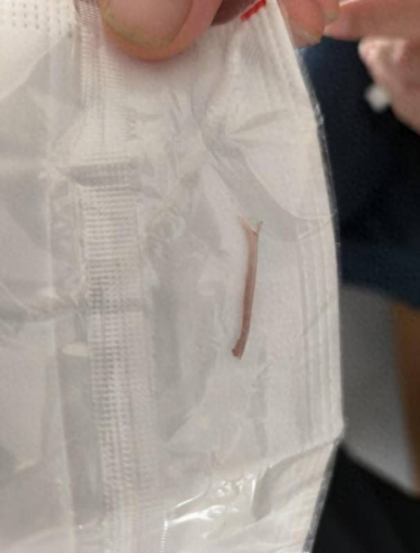 误吞鱼刺竟致胃穿孔？医生提醒：端午将至，警惕胃异物穿孔