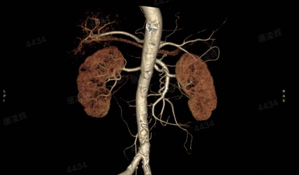 4种降压药都控不住，手腕上“打个孔”就解决了？省医南院“减压黑科技”上新→