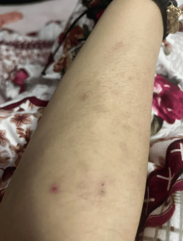 从全身溃烂到皮肤光滑，我的特应性皮炎治愈之路