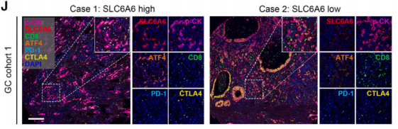 SLC6A6介导的牛磺酸缺乏促进胃癌免疫逃逸