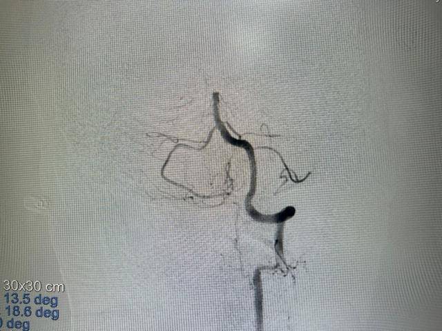 惊险！62岁房颤患者突发脑梗命悬一线，医生上演“生死时速”成功救命