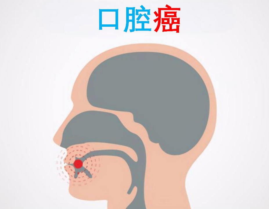 【健康科普】口腔癌的早期预防：健康生活的第一道防线