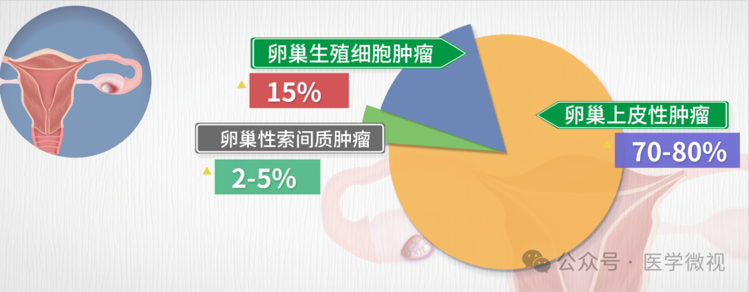 下腹痛腹胀别大意！中老年女性如何揪出“妇癌之王”的蛛丝马迹？