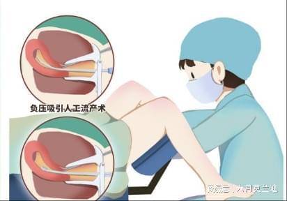 做药流还是人流，不想当“准爸妈”的育龄期人士看过来