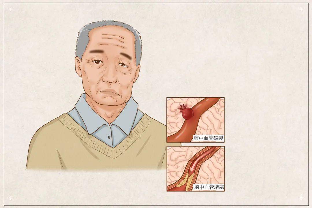 夏季谨防中风！医生推荐3款食疗方！ | 珠海医院