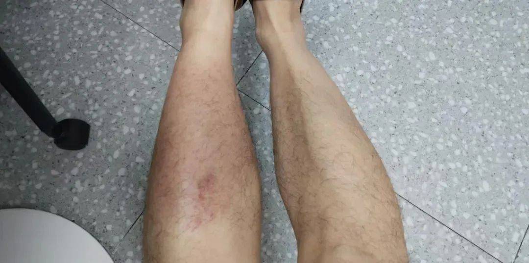 雨中蹚了一回水，男子烧到40℃，还染上丹毒…