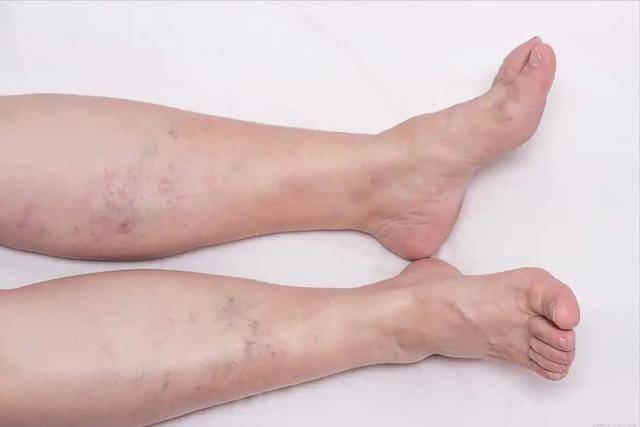 血栓多数无征兆？医生提醒：手脚若经常出现3种异样，需警惕重视