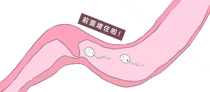 容易引起输卵管堵塞的5件事，女性可能都做过