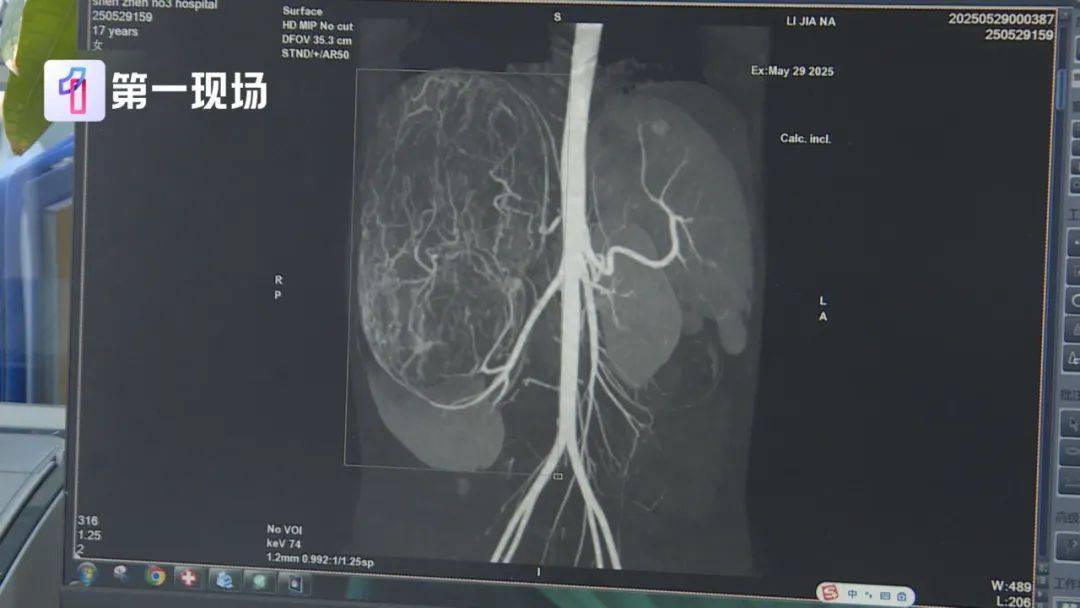 17岁女孩确诊癌症，服装店员一句提醒很关键