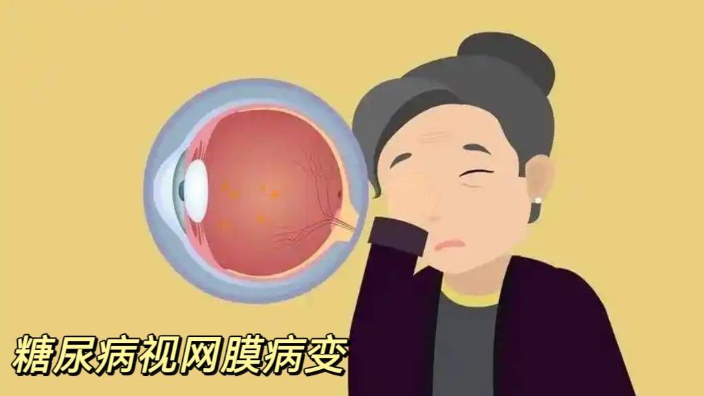 沉默的视力杀手——糖尿病视网膜病变