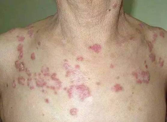 内脏有癌，皮肤先知！