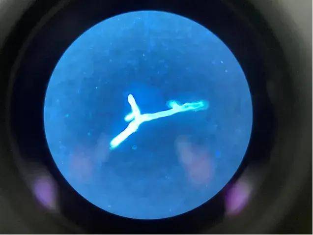 鼻腔剧痛、肺部“长毛”……毛霉菌长到身上后果很严重！