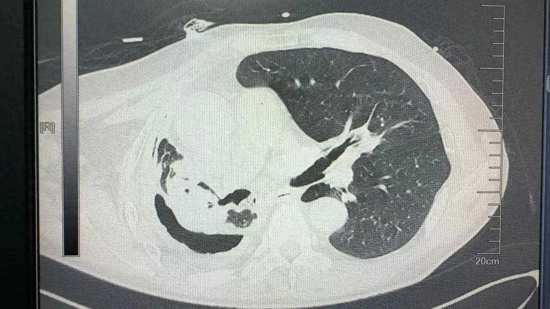 高难度结核毁肺手术，为心脏危疾患者突破手术禁忌