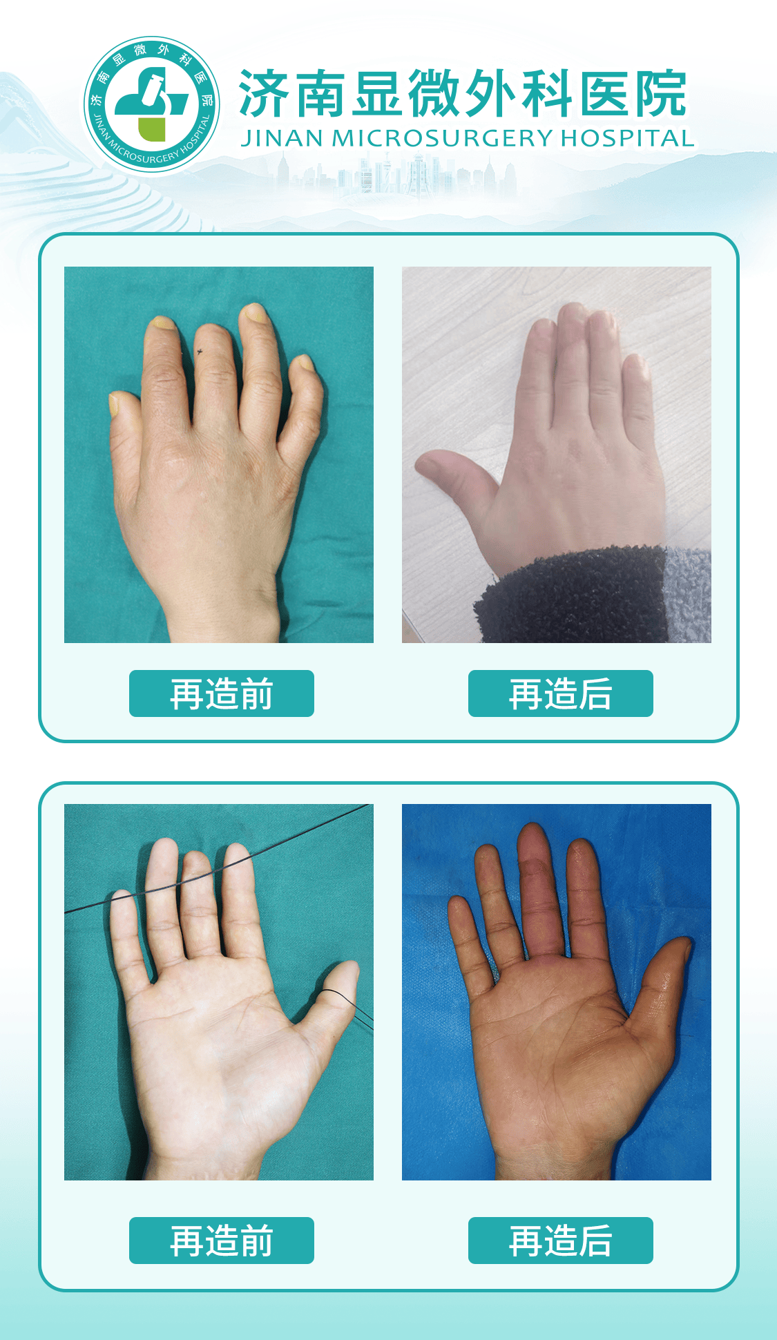 毫米之间见真章，精益求精的济南显微外科医院手指再造技术