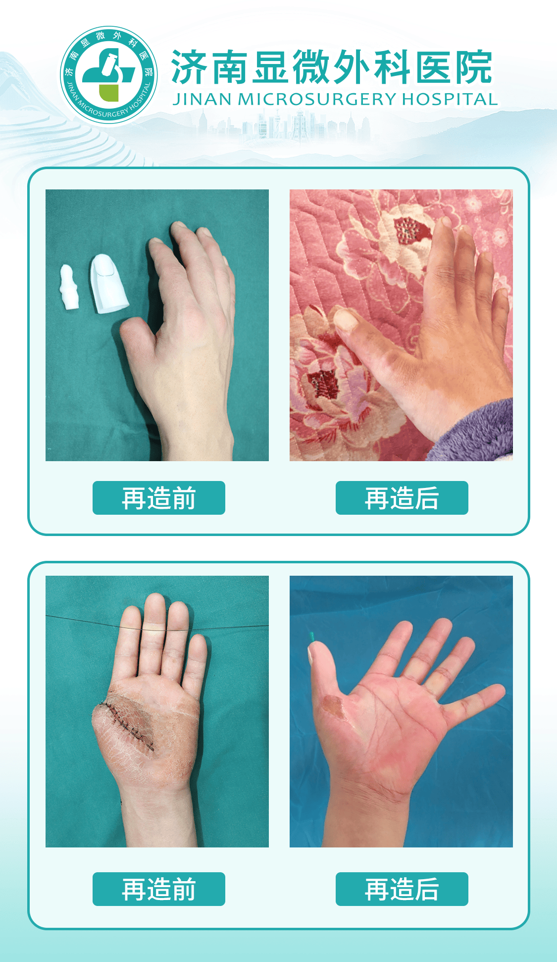 3D全形手指再造技术原理及对患者的要求