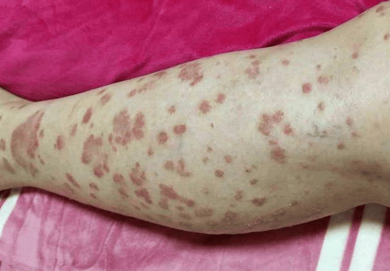 强烈安利！亲测有效的牛皮癣治疗方案，让我重获光滑皮肤