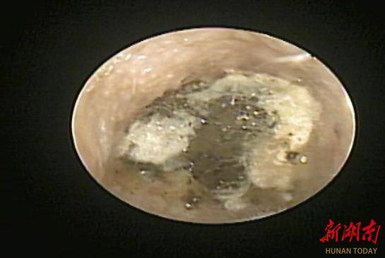 男子采耳后真菌感染 耳鼻喉科医生：采耳时，这3个误区别踩！