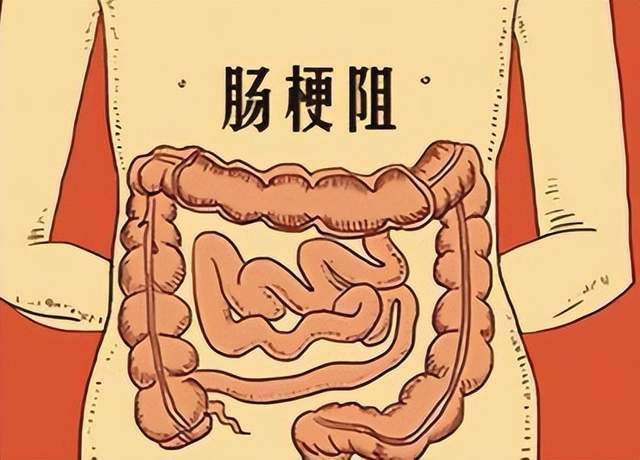 原创            肠梗阻拖延1小时，肠坏死风险增加30%！这些腹痛信号千万别忍
