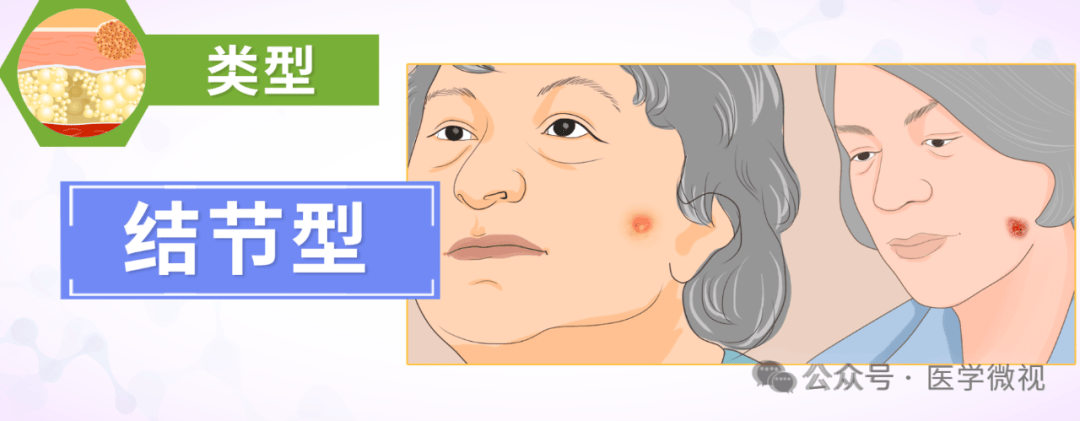 皮肤突现这类“信号”别大意，医生紧急提醒！