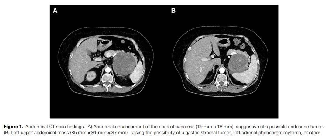 25年前罹患泌乳素瘤，如今继发肾上腺皮质癌，检出MEN1基因杂合突变确诊MEN1综合征