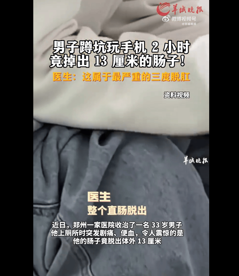 男子蹲坑玩手机2小时掉出13厘米肠子！医生：这属于最严重的三度脱肛