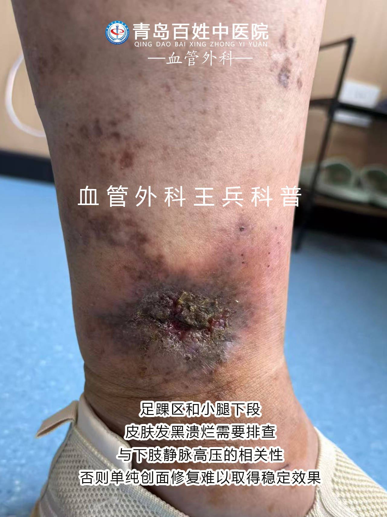 青岛百姓静脉曲张专科|如何早期发现静脉曲张