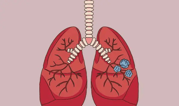 李勇医生教你科学护肺：5 步远离肺结节困扰